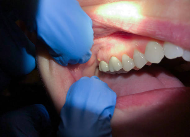 Best Knocked-Out Tooth Emergency  in Livingston, MT