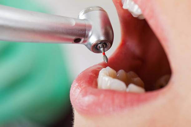 Best Dentist for Tooth Abscess  in Livingston, MT